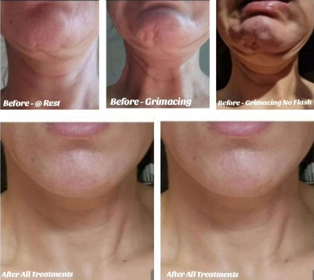 Photograph image of before and after Morpheus 8 and several non-surgical treatments of the neck including Botox and fillers and lasers and microneedling with radiofrequency at Monaco Medical Spa in Miami Florida