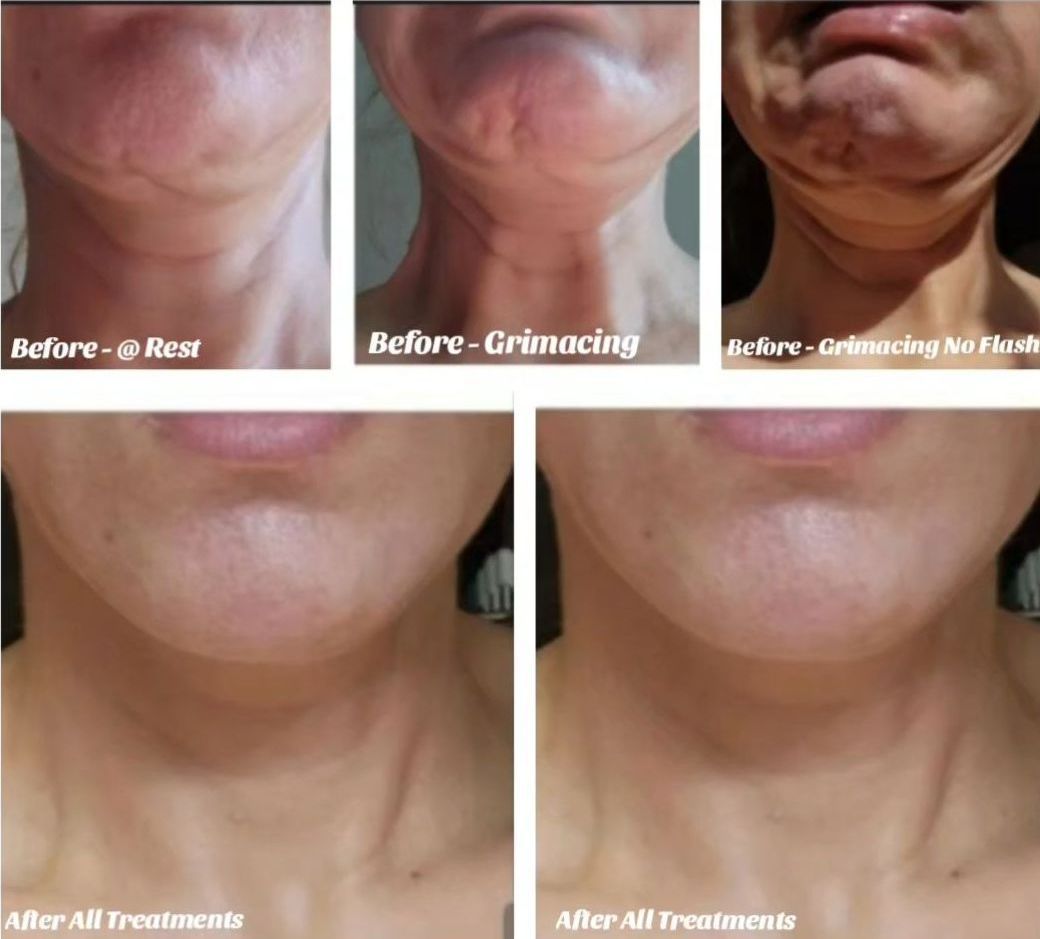 Morpheus8 Face & Neck x 3 Treatments. 
Jaw Contouring & Chin Filler.
Biostimulating Neck Fillers x 2 Treatments. 
Neck Bands, Nefertiti Jawline, Chin & Marionette Lines (DAO) Botox.
Top Row Left: Before, At Rest.
Top Row Right: Before, Contracting Chin & Neck Muscles.
Bottom Row Right: Before, Contracting Chin & Neck Muscles Under Lighting.
Bottom Row Left: 7 Months After All Treatments. photo of morpeus8  of neck, botox, sculptra and radiesse fillers at Monaco med spa located in Miami midtown edgewater downtown, FL