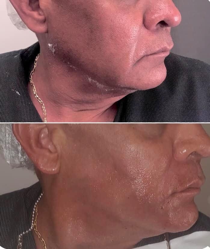 Monaco Med Spa, Miami, FL, Before and After, Midtown miami, Edgewater Miami, FL, PDO nonsurgical Thread faceLift and necklift, face lift, neck lift Monaco med spa in downtown worldcenter edgewater midtown Miami, FL, photo of Before and After pdo thread nonsurgical facelift, face lift. neck lift, and neck lift  Midtown Miami, FL