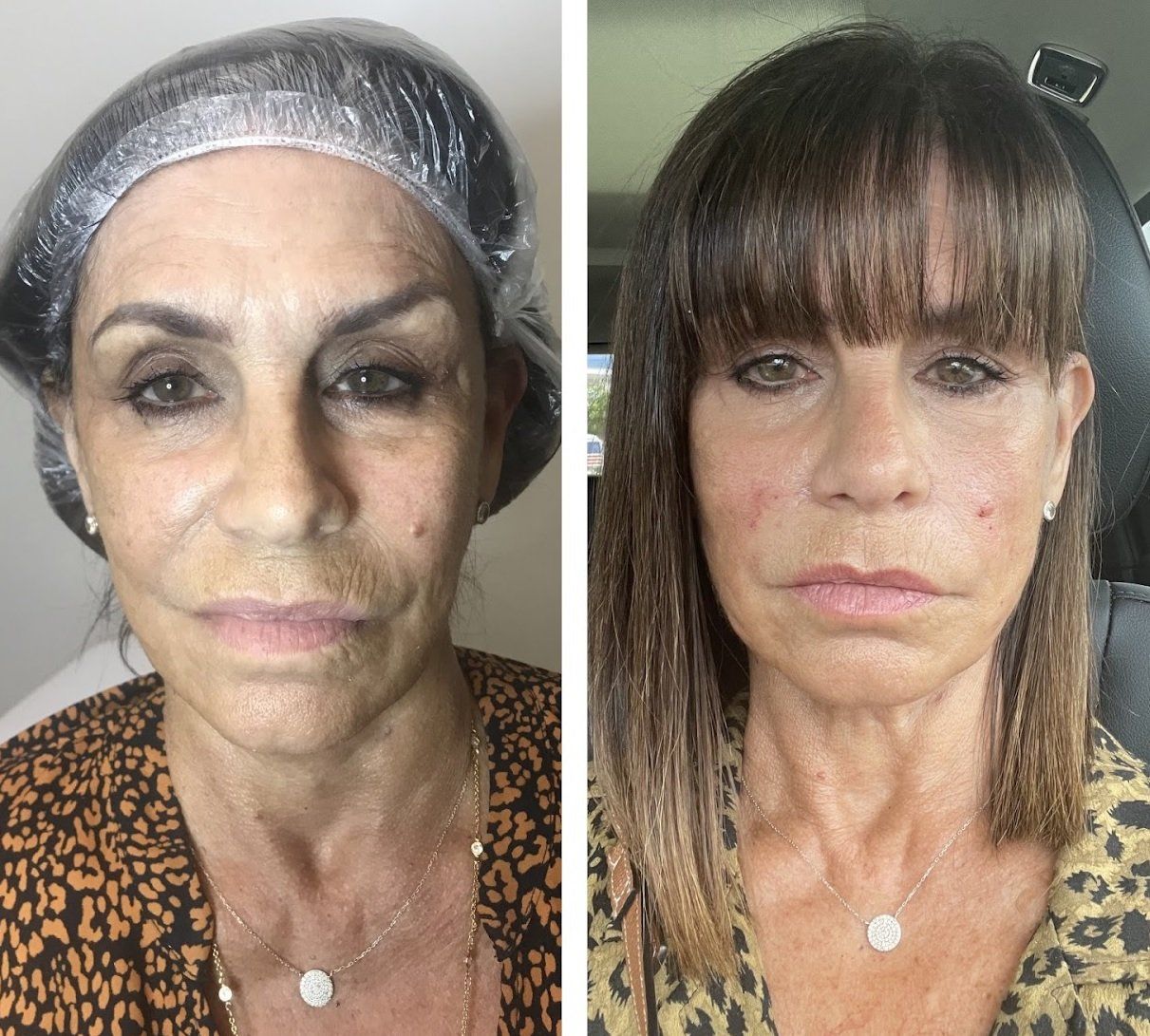 Monaco MedSpa Before and After Gallery, Real Clients, Real Results