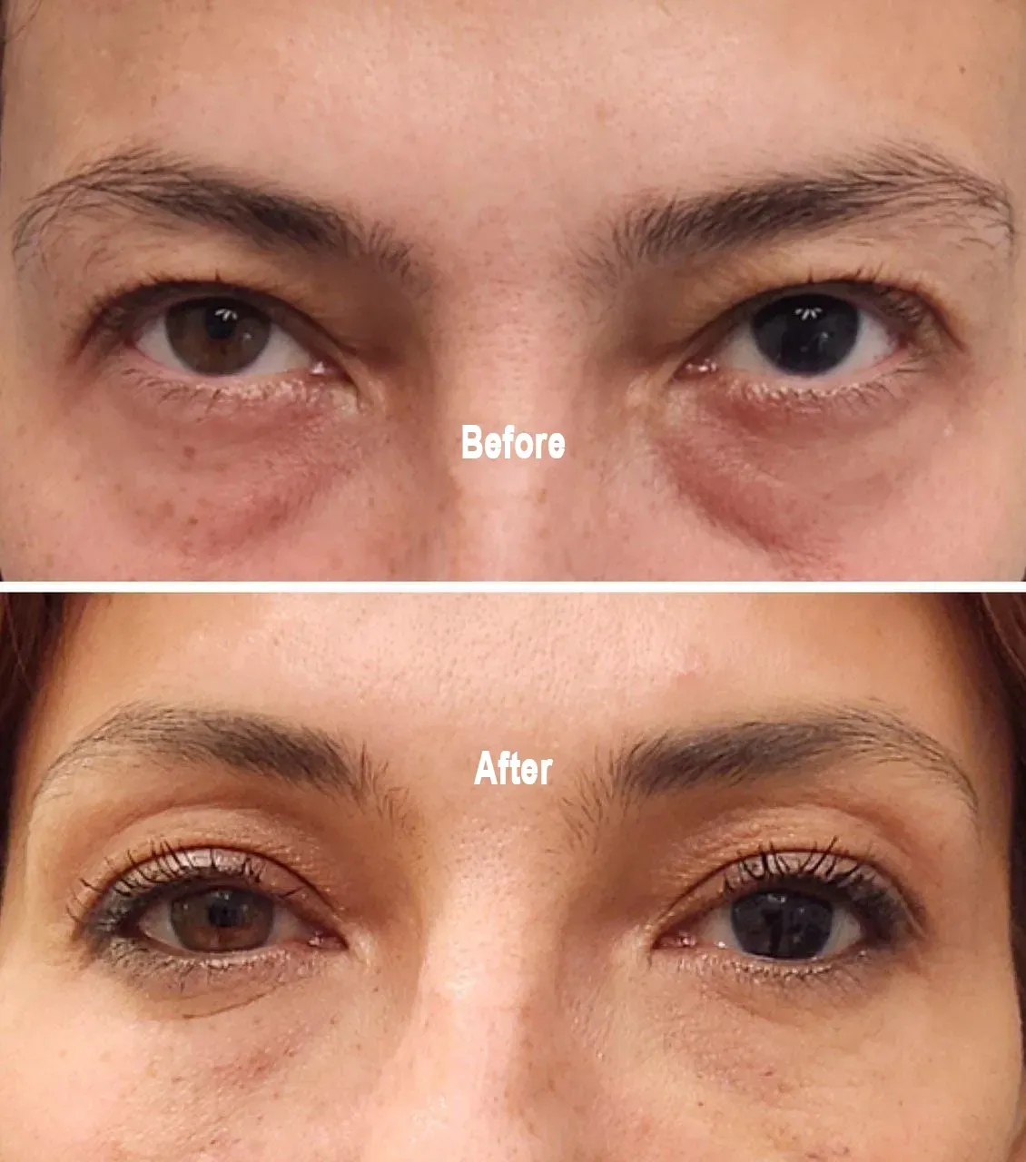 Before and after Morpheus8 for the eyes. Before and after Morpheus8 for the eyes, Monaco Medspa, medical spa, Miami FL.