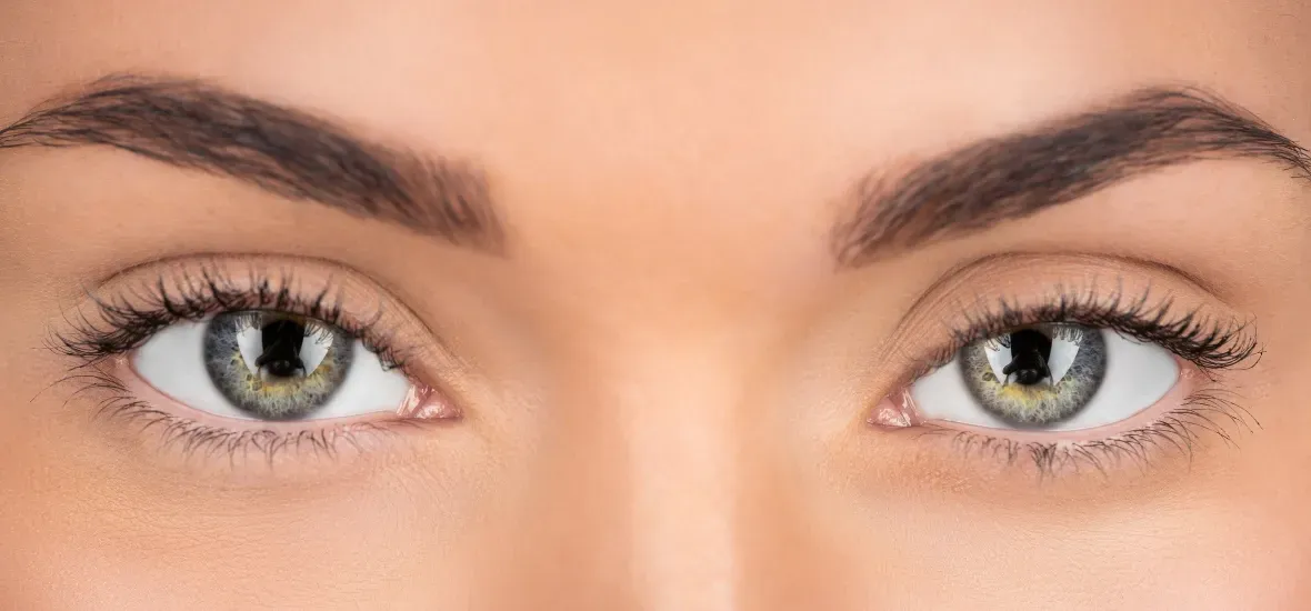 Tear Trough, Under Eyelid Filler image, Monaca MedSpa in Miami FL.