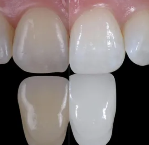 Before and after of teeth — Teeth Whitening in Central Coast, NSW