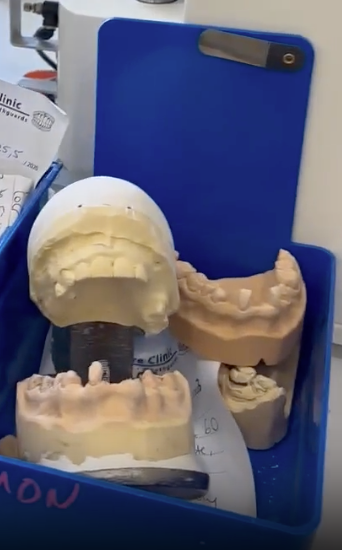 Different types of teeth molds — Denture Remodelling in Central Coast, NSW