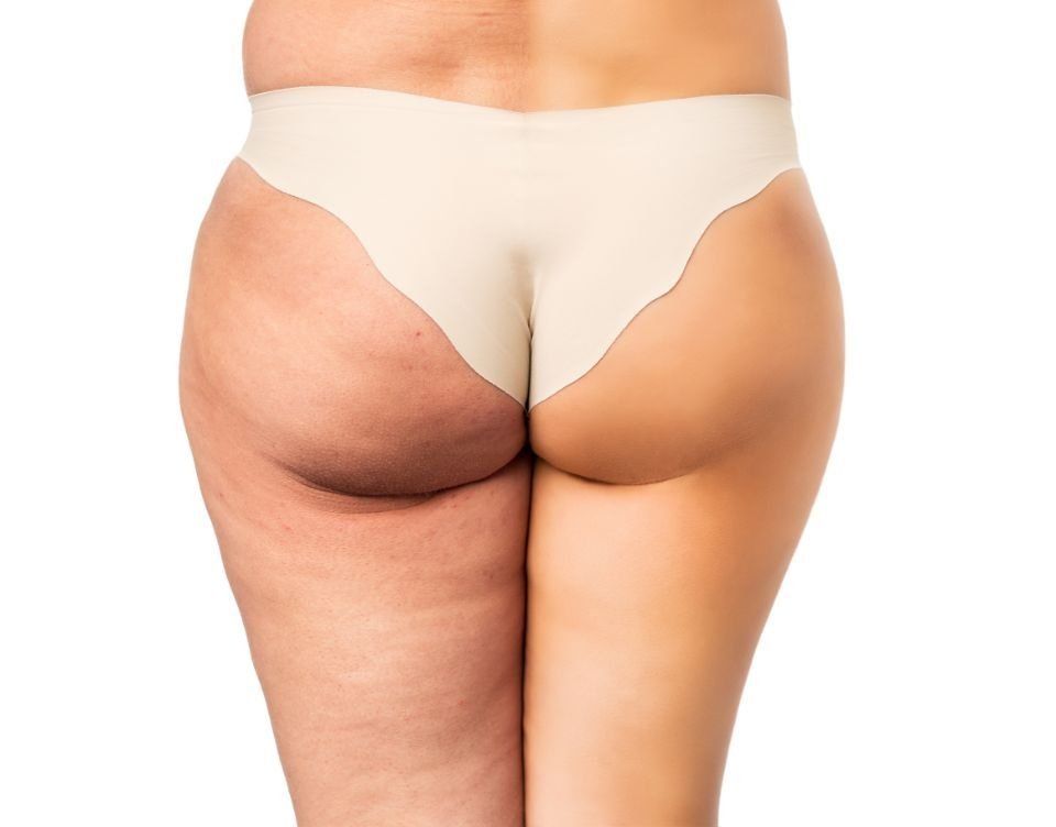 Cellulite