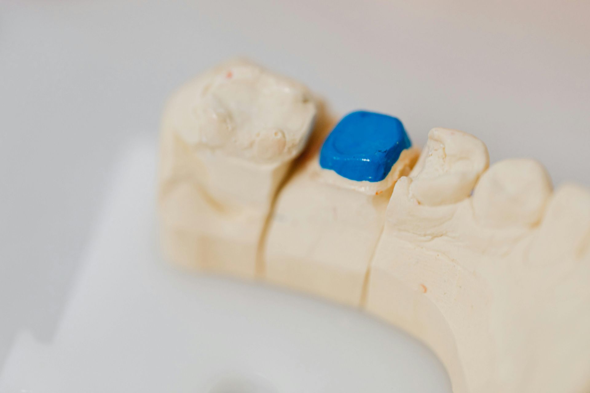 A Close Up Of A Model Of A Tooth With A Blue Block On It — Steve King Dental Group in Manunda, QLD
