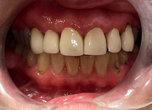 A close up of a person 's teeth with a clear mouth guard.