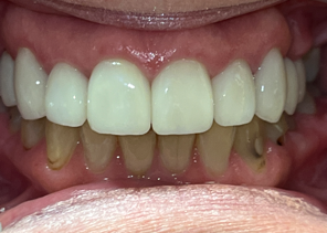 A close up of a person 's teeth with white teeth.