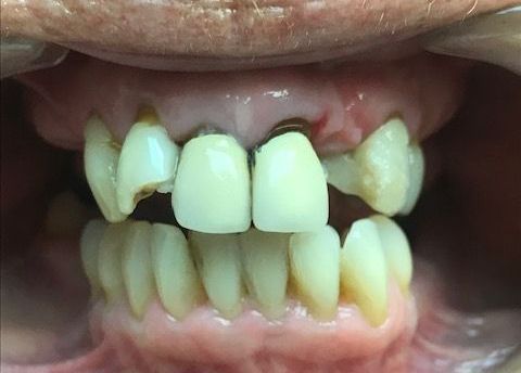 A close up of a woman 's mouth with missing teeth.