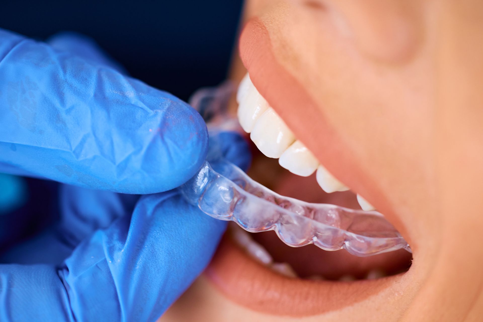 Gloved hand inserting clear aligner into open mouth, close-up view showing teeth and lips.