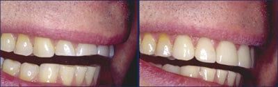 A before and after picture of a person 's teeth.