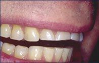 A before and after picture of a person 's teeth.
