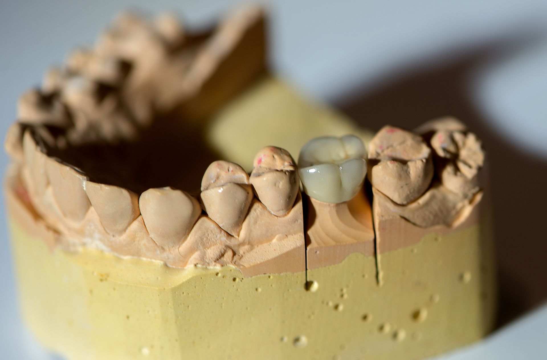 Dental model showing a prepared tooth with a ceramic crown.
