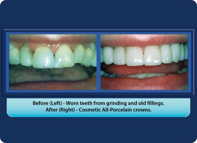 A picture of a person 's teeth before and after cosmetic all-porcelain crowns