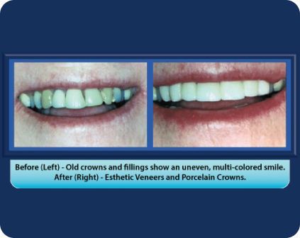 A before and after picture of a woman 's smile