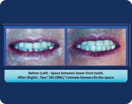A before and after picture of a woman 's teeth