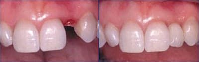 A before and after picture of a tooth with a hole in it.