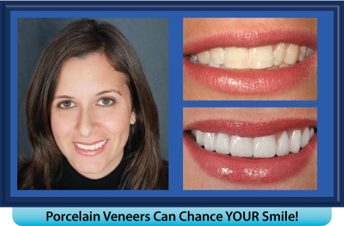 A woman with porcelain veneers on her teeth is smiling
