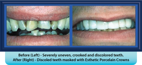 A before and after picture of a person 's teeth