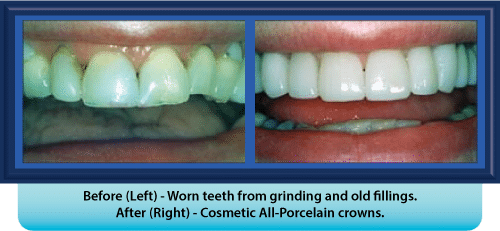 A picture of a person 's teeth before and after cosmetic all-porcelain crowns
