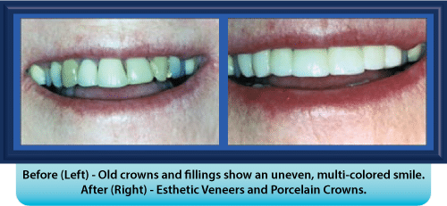 A before and after picture of a woman 's smile with porcelain crowns
