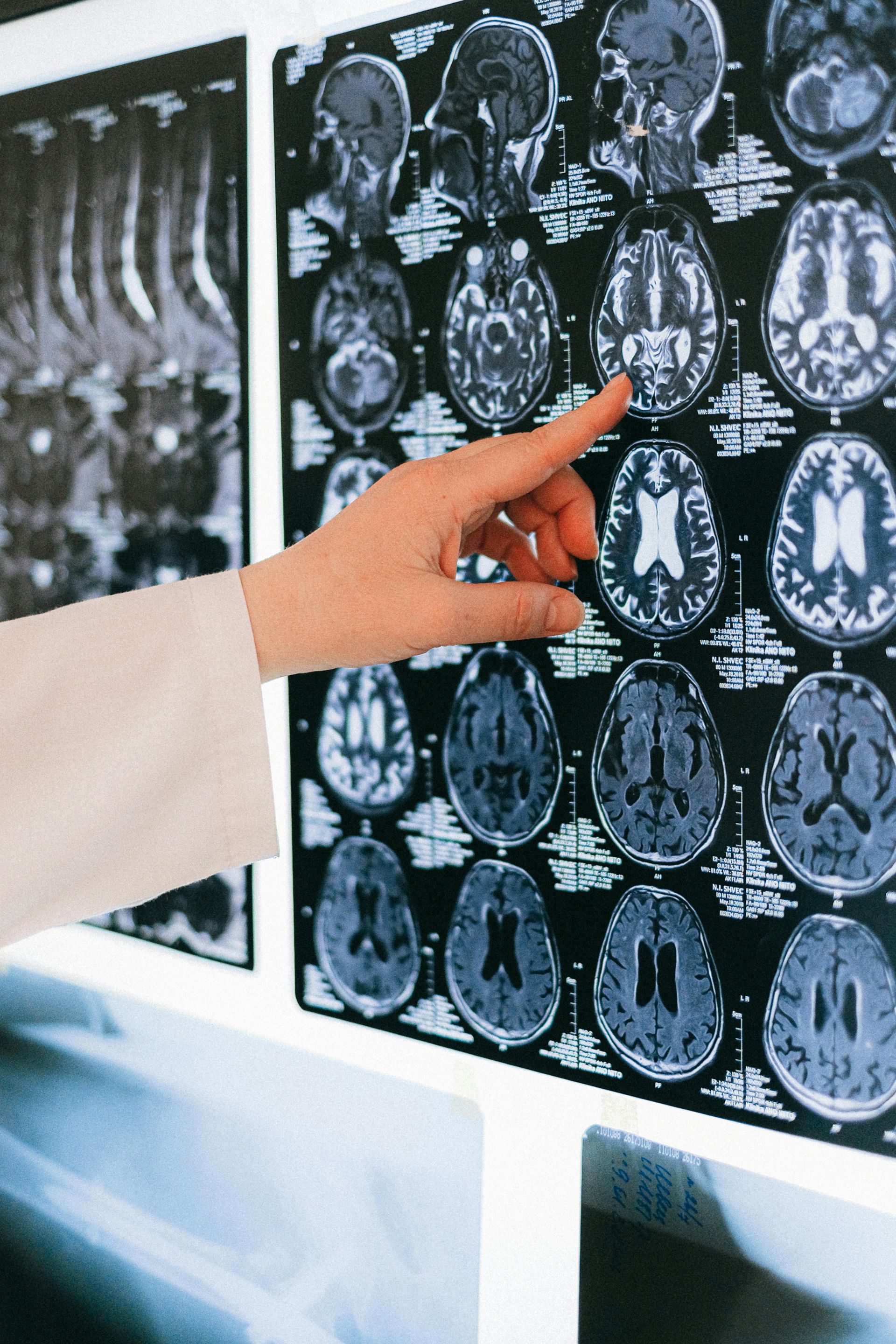 A person’s hand points to a specific section of a brain MRI scan displayed on a light box.