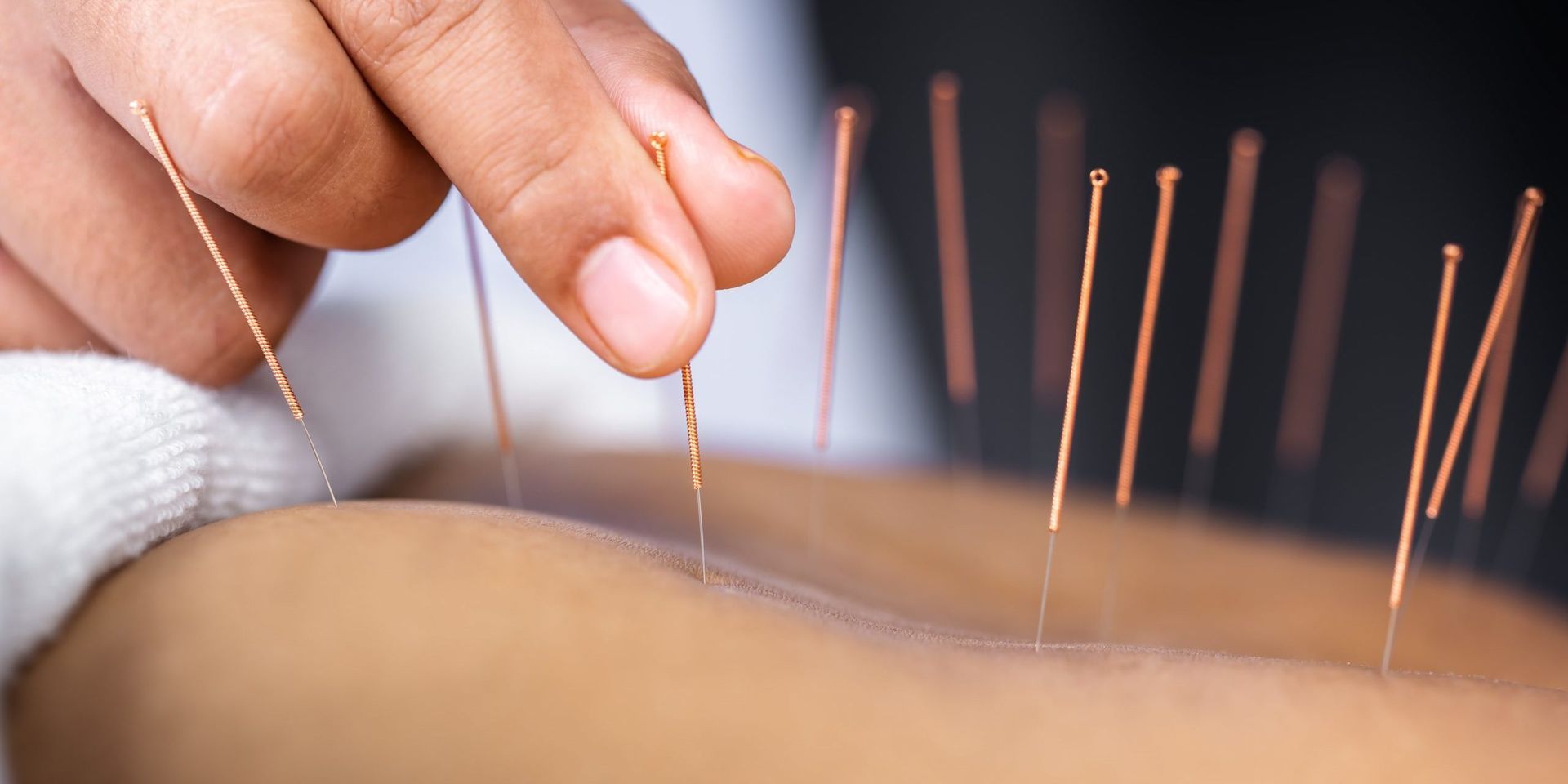 Acupuncture on their back to relieve pain. 