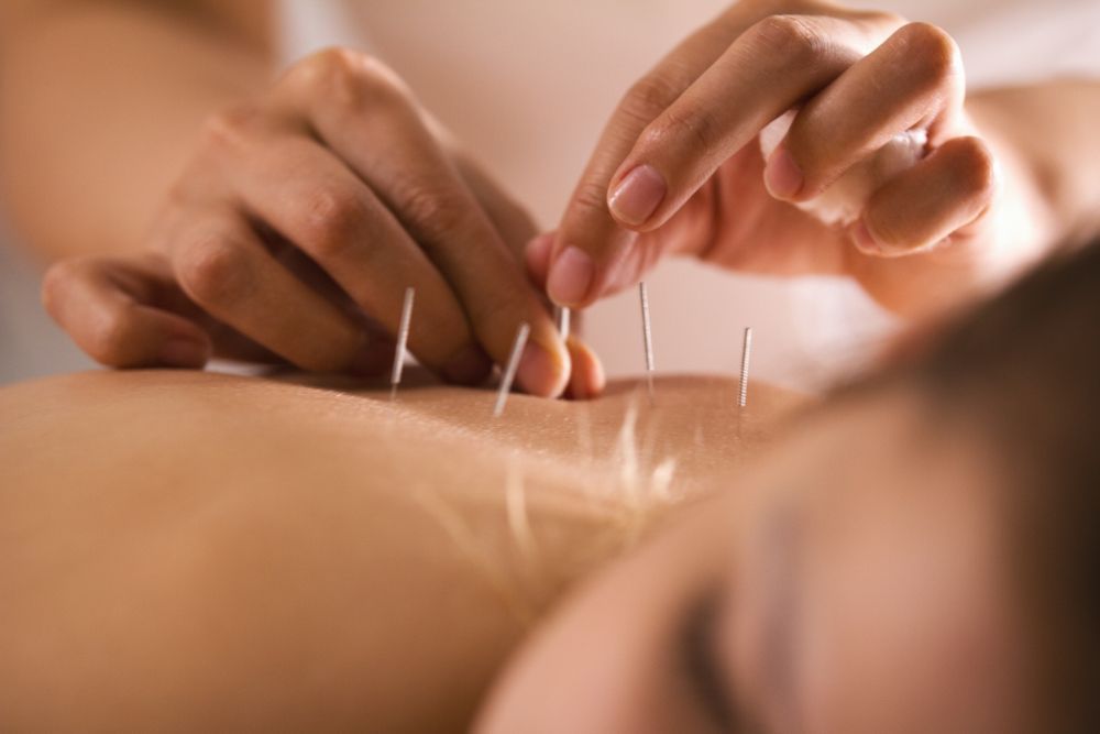 Woman Undergoing Acupuncture Treatment