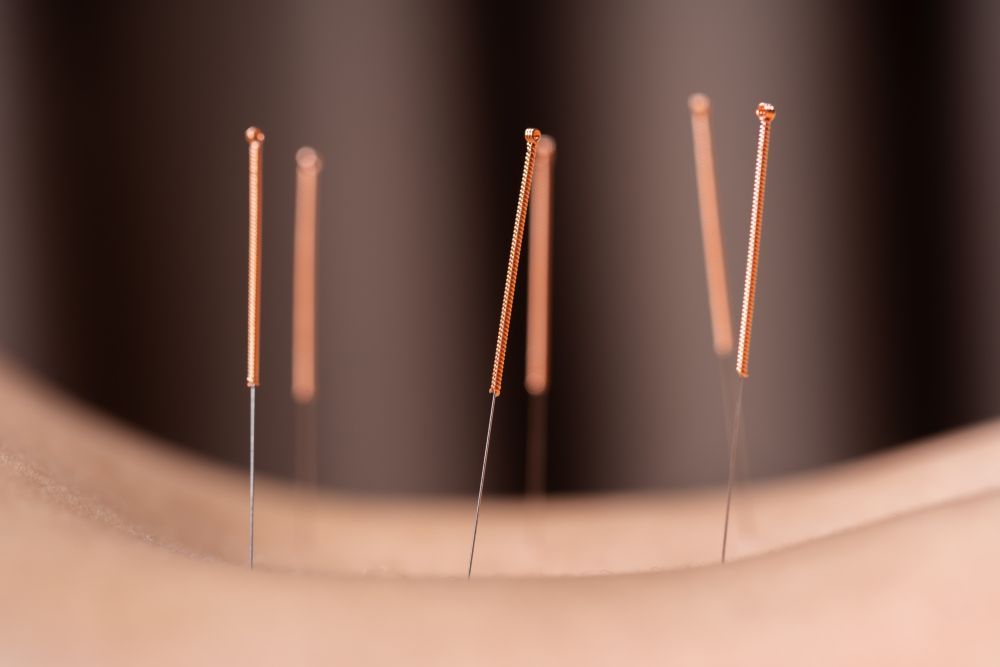 Acupuncture Treatment