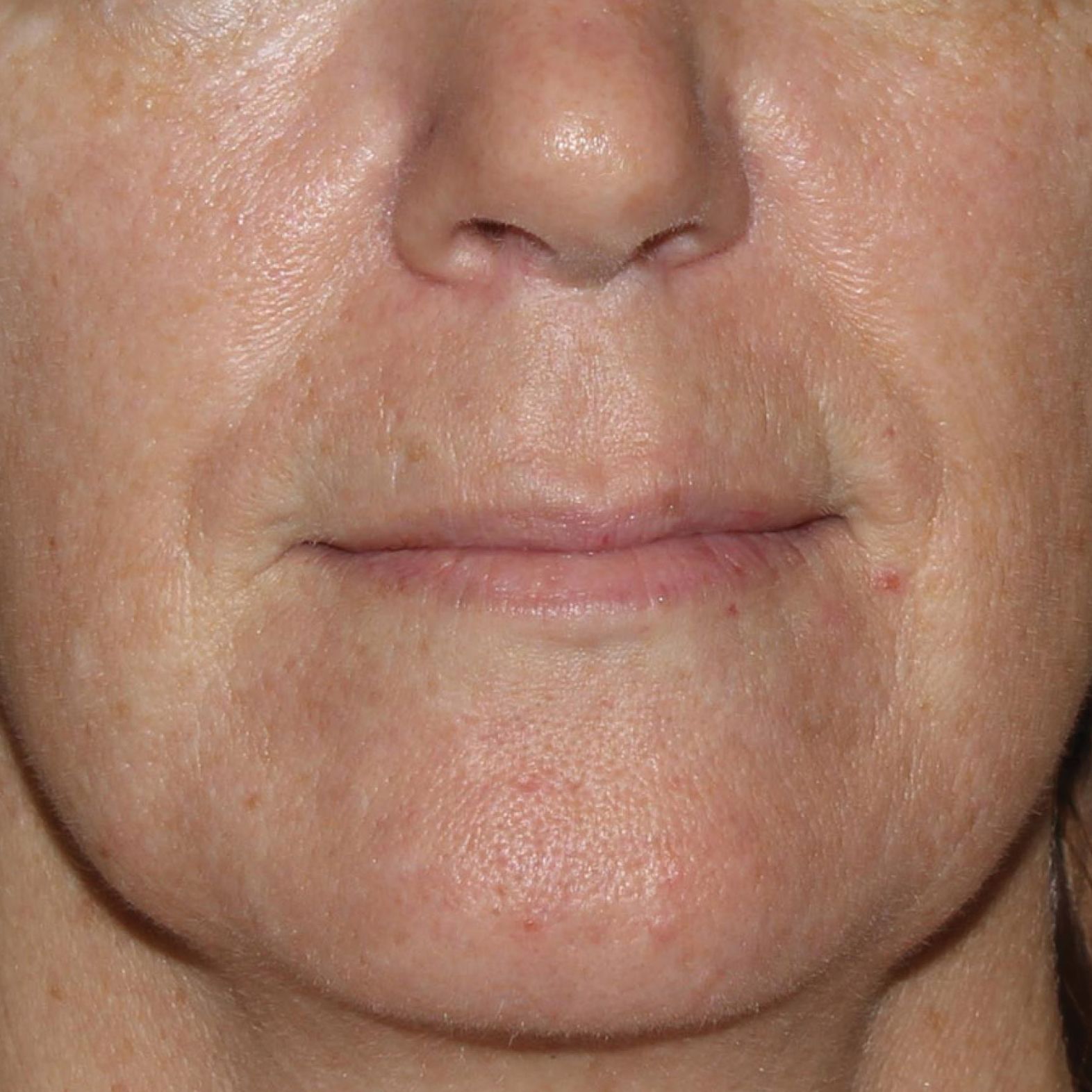 a close up of a woman 's face with her mouth open before treatment