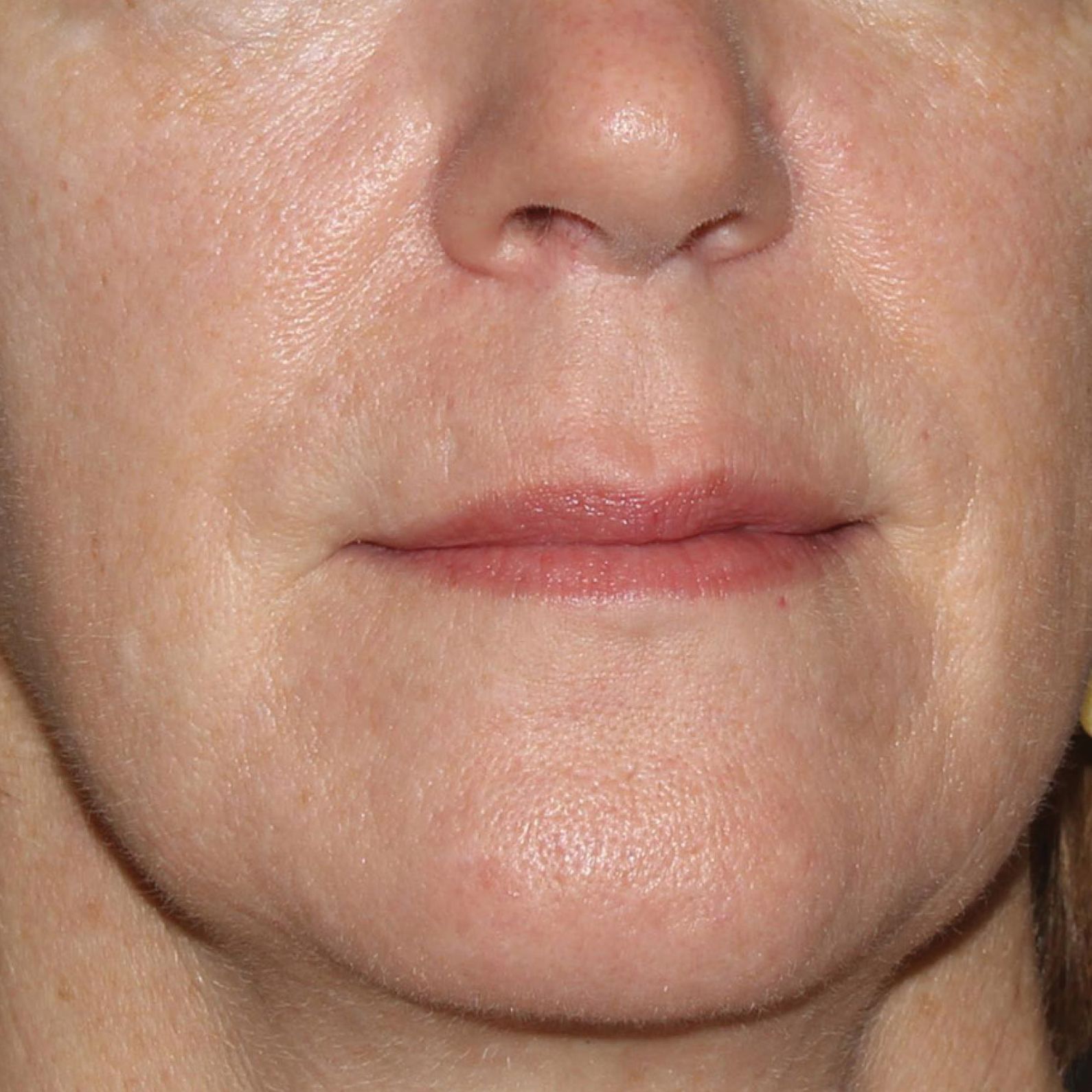a close up of a woman 's face with a pink lips after treatment