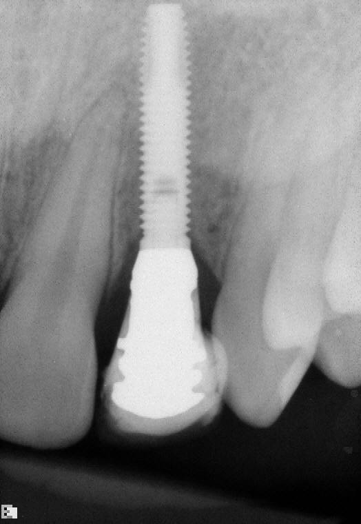 Dental implant — Dental Implants in Sequim, WA