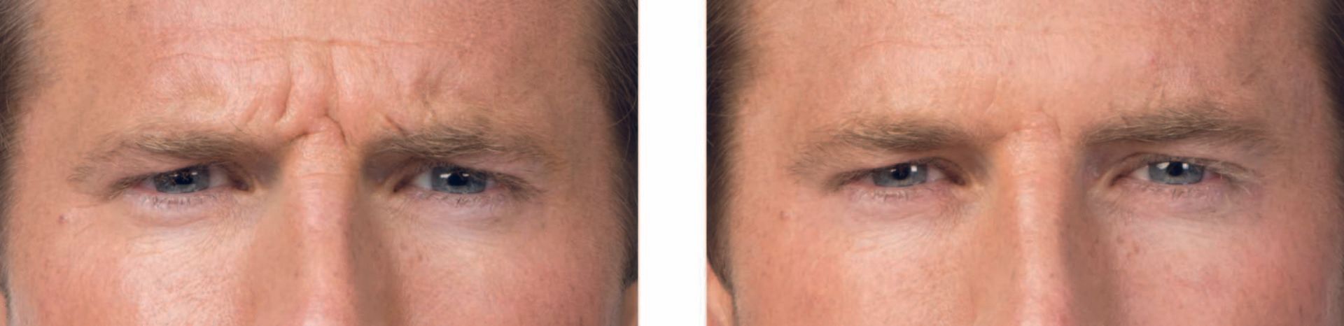 botox before and after photos