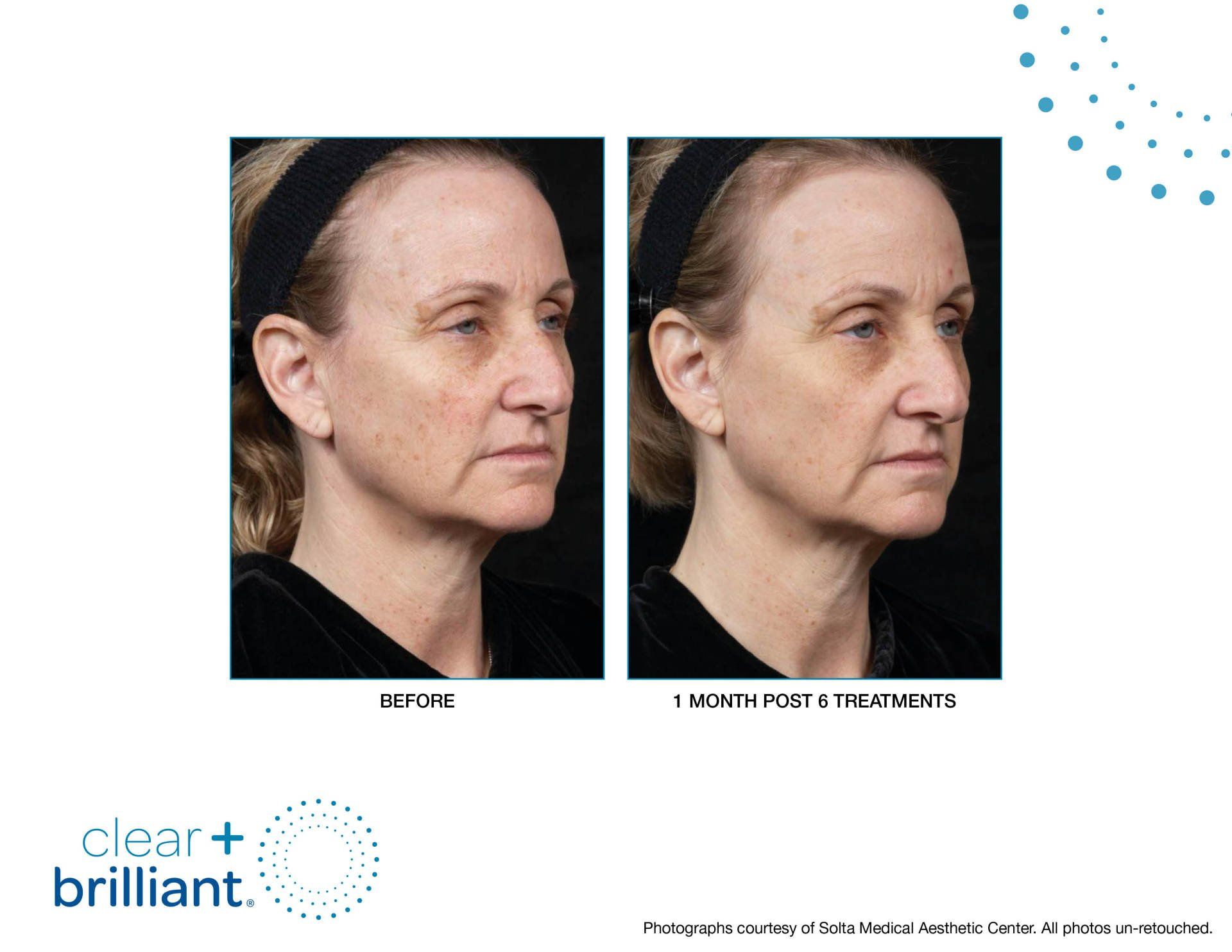 CLEAR BRILLIANT LASER | FOLSOM DERMATOLOGY | FOLSOM, CA