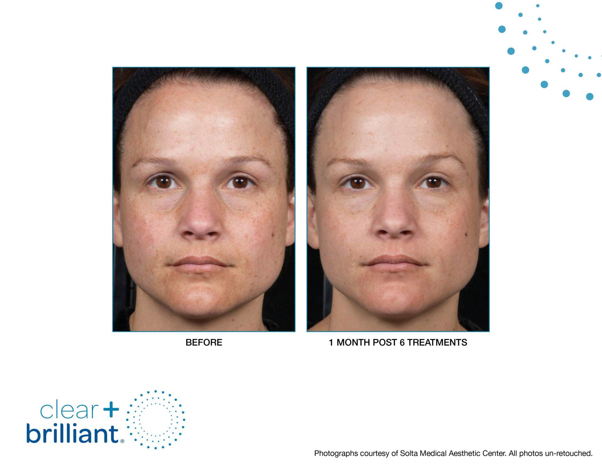 CLEAR BRILLIANT LASER FOLSOM DERMATOLOGY FOLSOM, CA