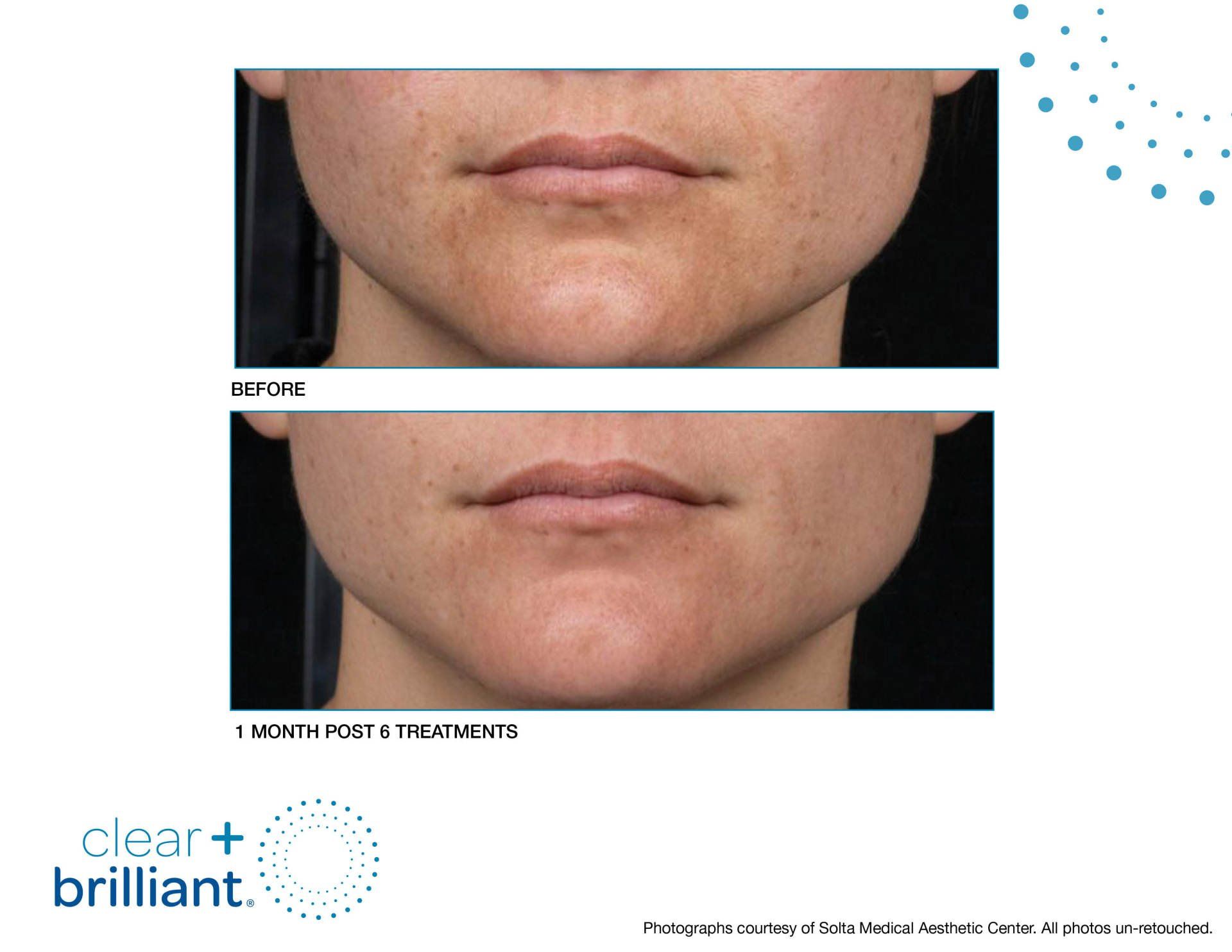 clear and brilliant before and after photos