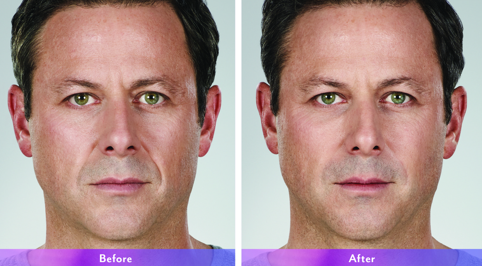 Juvederm before and after photos