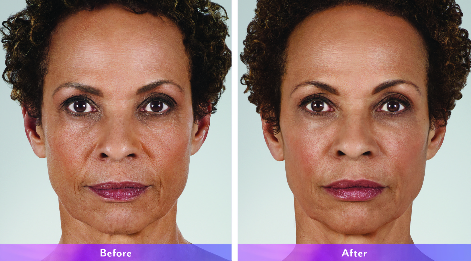 Juvederm before and after photos