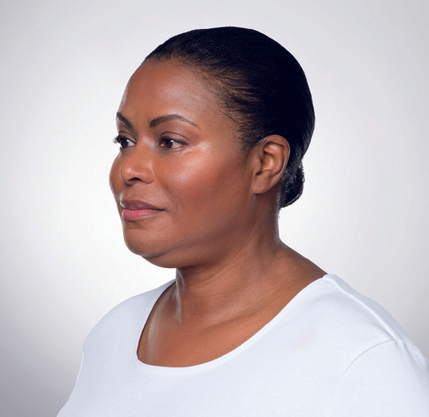 Kybella before and after photos