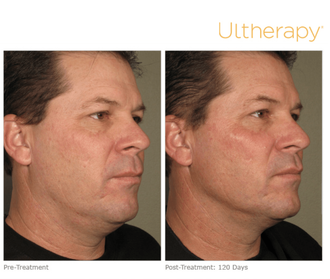 Ultherapy Before and After Photos