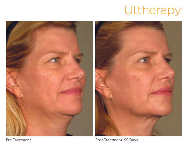 ultherapy before and after photos