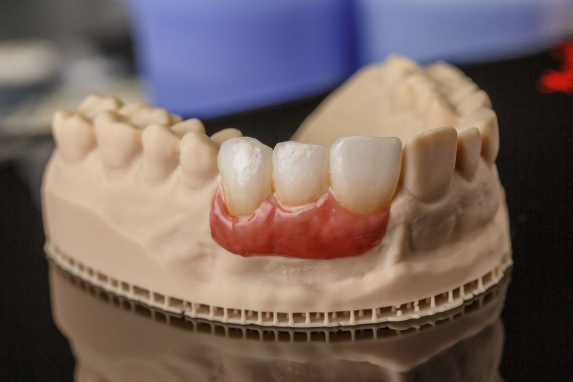 Primo piano di un modello dentale con una protesi dentaria.