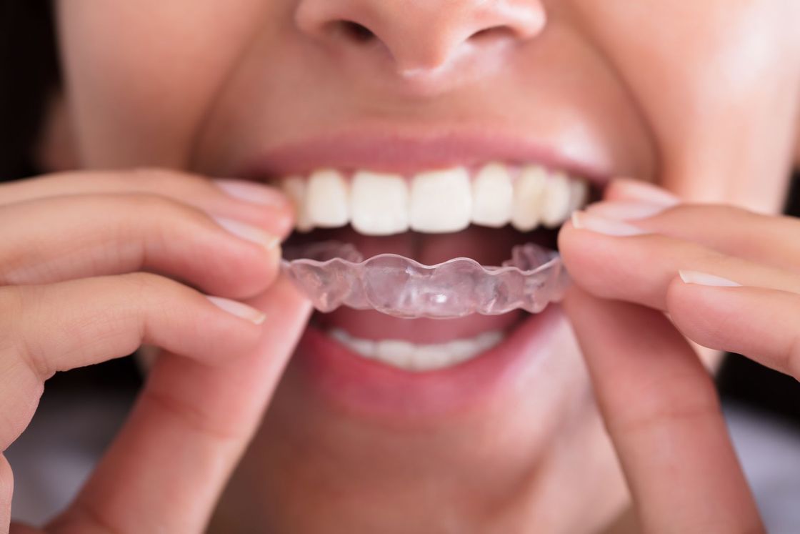 Una donna sta mettendo un apparecchio trasparente ai denti.