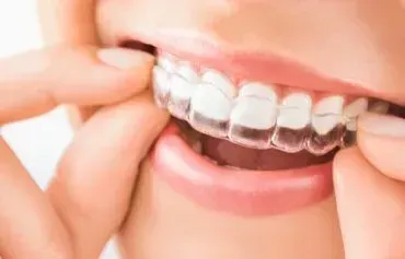A woman is putting a clear brace on her teeth.