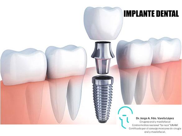 JORGE ALBERTO FERNANDO VARELA LÓPEZ-implante dental
