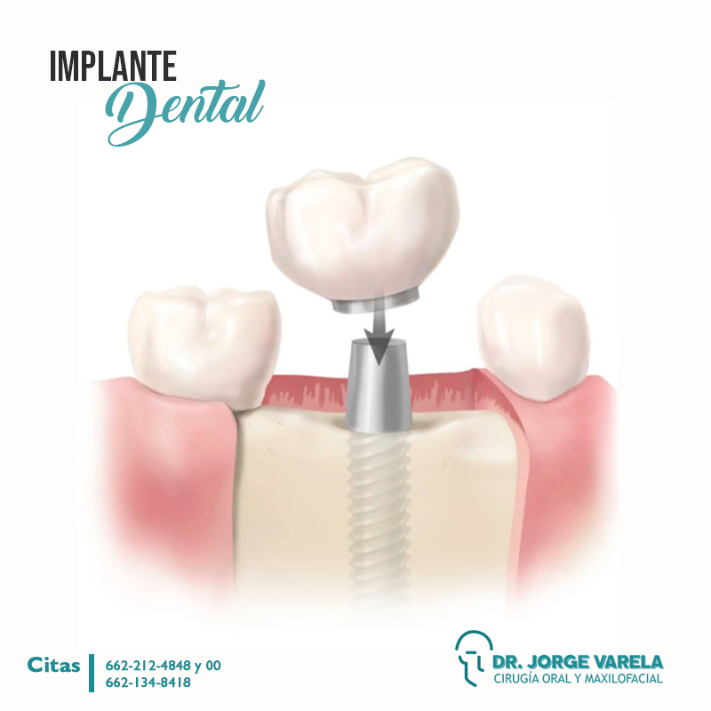 JORGE ALBERTO FERNANDO VARELA LÓPEZ-implante