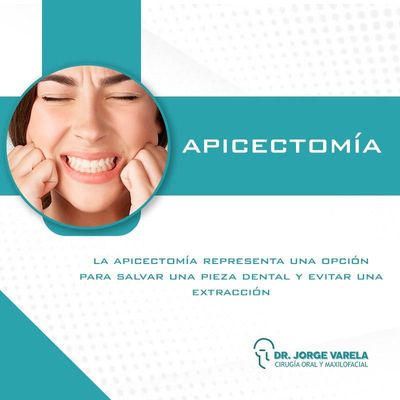 Apicectomía