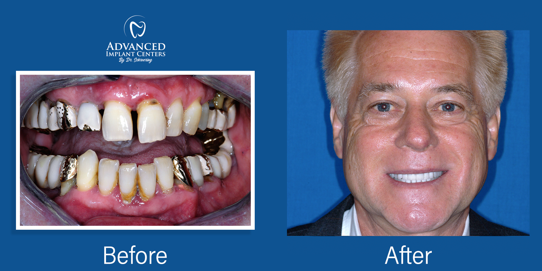 Dental Implants Marion, IN & Louisville, KY 5022684840