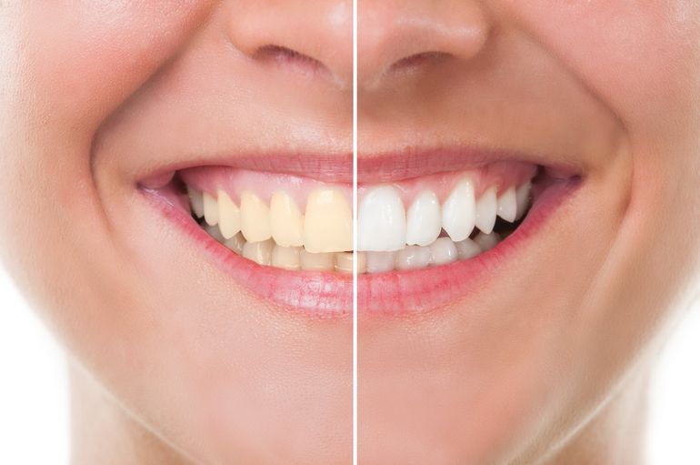 Chaddesden Dental Surgery, before and after photo of teeth whitening