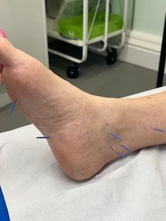 A person is getting acupuncture on their foot.